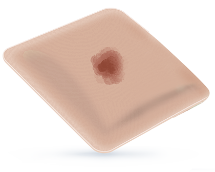 50% EXUDATE FOAM COVERAGE